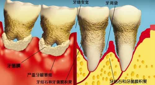 为什么说牙周病是可以预防的疾病